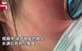 小姐姐亲猫，脸上竟长了「脚气」！养宠这些卫生问题千万别忽略 小姐姐亲猫,脸上竟长了一个包