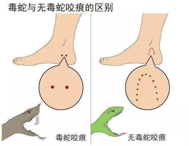 毒蛇咬伤的并发症，毒蛇咬伤症状可分为哪3类